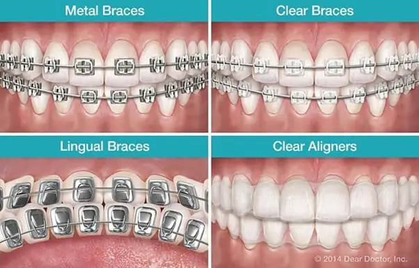 Dental Braces Service - Solitaire Family Dentistry