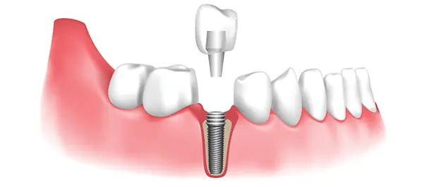 Dental Implants Service - Solitaire Family Dentistry