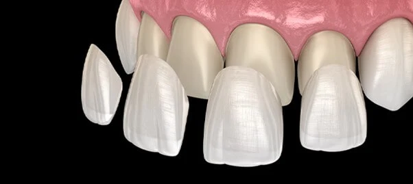 Dental veneers Service - Solitaire Family Dentistry