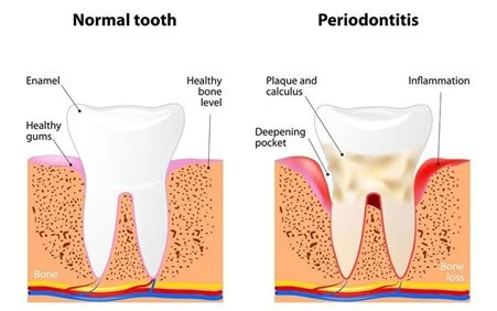 Gum flap surgery service - Solitaire Family Dentistry