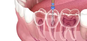 Root canal Treatment Service - Solitaire Family Dentistry