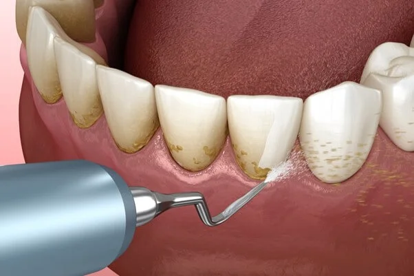 Teeth scaling & root Planing - Solitaire Family Dentistry