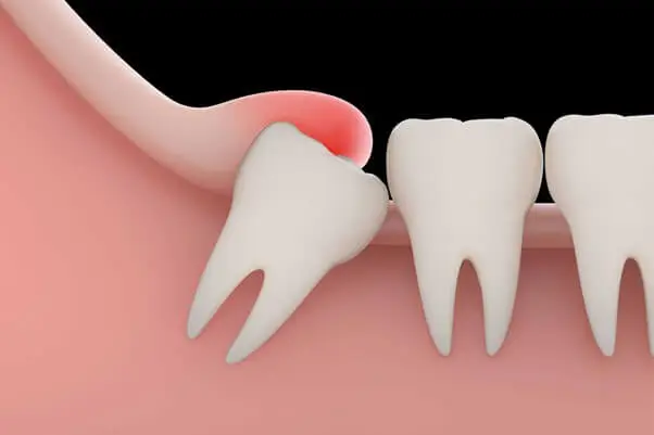 Wisdom tooth removal service - - Solitaire Family Dentistry