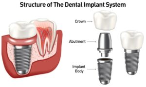 Structure of the Dental Implant System