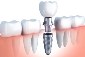 Structure of the Dental Implant System