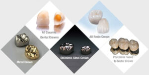 Types Of Dental Crown