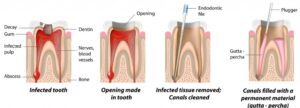 Root Canal