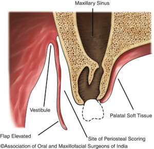 Maxillary Sinusitis of Dental Origin