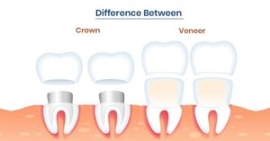 Difference between veneers and crowns