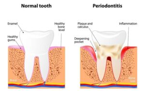 Teeth Gum