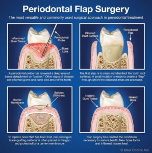 Paradental Flap Surgery