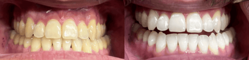 Solitaire Family Dentistry Before After Results 1
