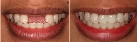 Solitaire Family Dentistry Before After Results 10