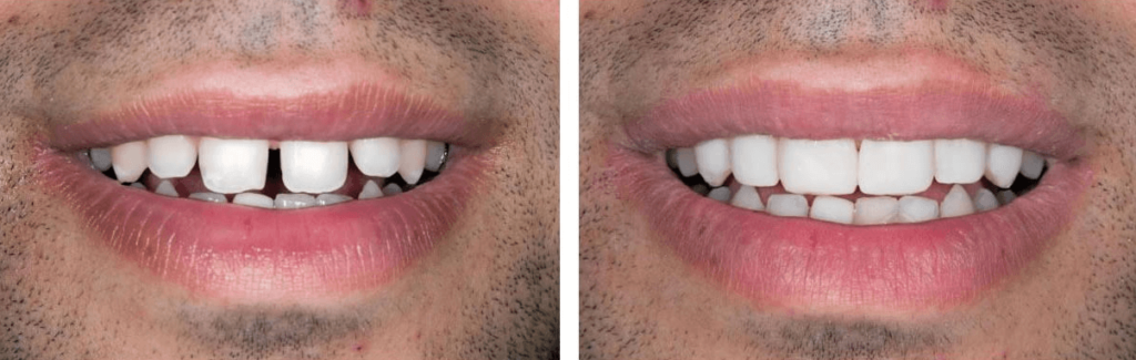 Solitaire Family Dentistry Before After Results 12