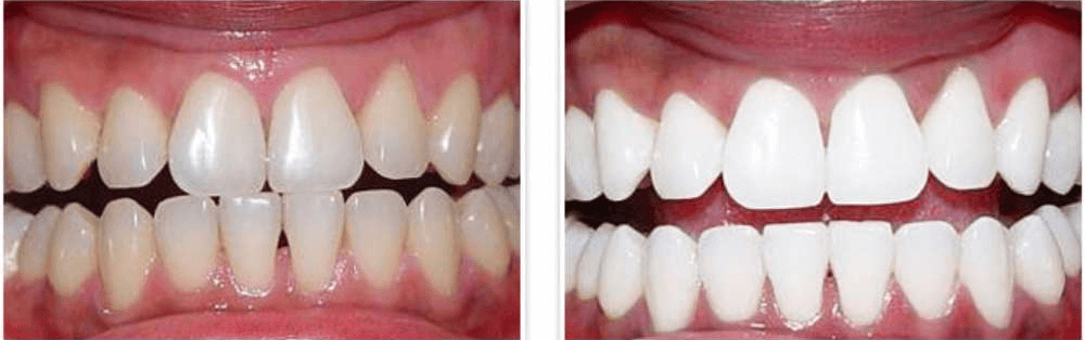 Solitaire Family Dentistry Before After Results 13
