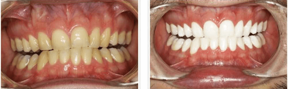 Solitaire Family Dentistry Before After Results 14