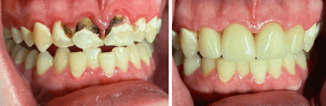 Solitaire Family Dentistry Before After Results 4