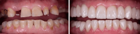 Solitaire Family Dentistry Before After Results 5