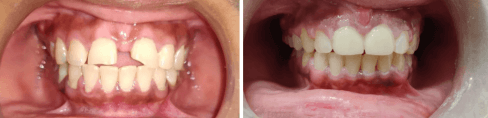 Solitaire Family Dentistry Before After Results 6