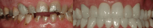 Solitaire Family Dentistry Before After Results 7