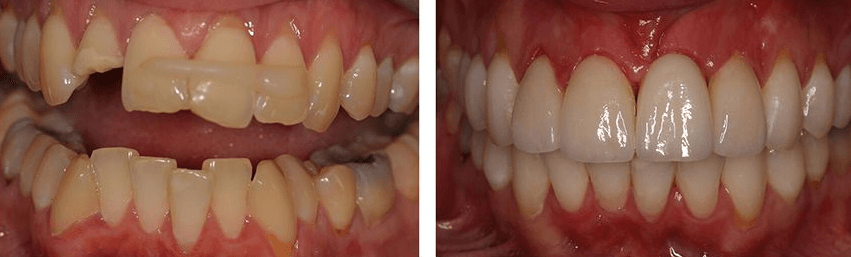 Solitaire Family Dentistry Before After Results 8