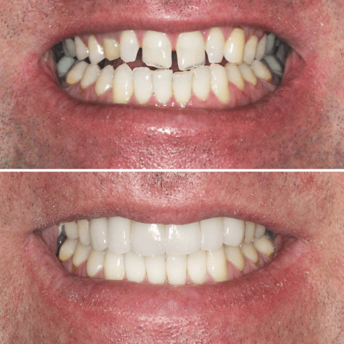 Solitaire Family Dentistry Before After Results 2